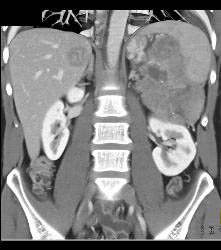 GIST Tumor With Ulceration - CTisus CT Scan