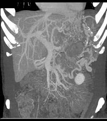 GIST Tumor With Ulceration - CTisus CT Scan