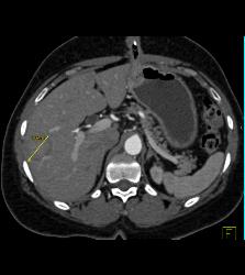 Tumor Recurrence Along G-tube With Liver Metastases - CTisus CT Scan