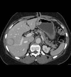 Tumor Recurrence Along G-tube With Liver Metastases - CTisus CT Scan