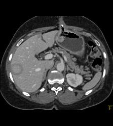 Tumor Recurrence Along G-tube With Liver Metastases - CTisus CT Scan