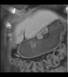 Gastric Adenocarcinoma - CTisus CT Scan