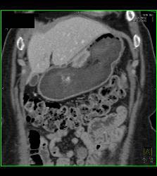 Gastric Adenocarcinoma - CTisus CT Scan