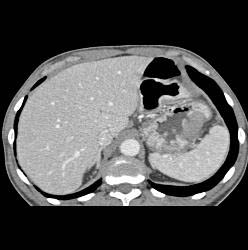 Bulky Tumor C/w Lymphoma Involving Stomach and Kidney - CTisus CT Scan