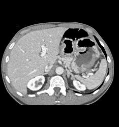 Bulky Tumor C/w Lymphoma Involving Stomach and Kidney - CTisus CT Scan