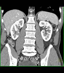 Bulky Tumor C/w Lymphoma Involving Stomach and Kidney - CTisus CT Scan