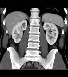 Bulky Tumor C/w Lymphoma Involving Stomach and Kidney - CTisus CT Scan