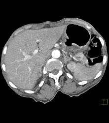 Gastric Adenocarcinoma With Celiac Nodes - CTisus CT Scan