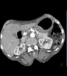 Gastric Adenocarcinoma With Celiac Nodes - CTisus CT Scan