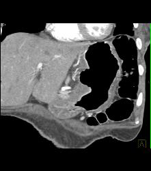 Gastric Adenocarcinoma With Celiac Nodes - CTisus CT Scan