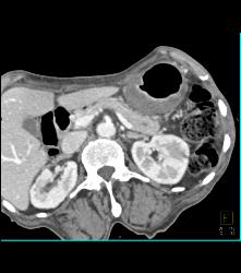 Gastric Adenocarcinoma With Celiac Nodes - CTisus CT Scan