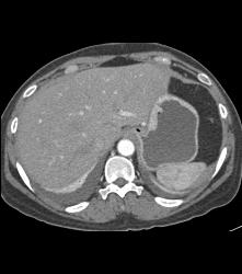 Gastric Carcinoma - CTisus CT Scan