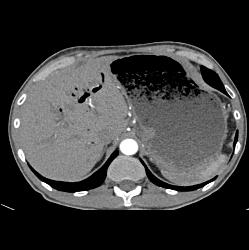 Antral Carcinoma With Peritoneal Tumor Implants - CTisus CT Scan