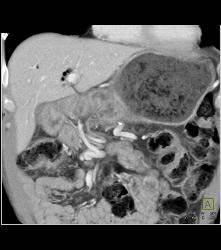 Antral Carcinoma With Peritoneal Tumor Implants - CTisus CT Scan