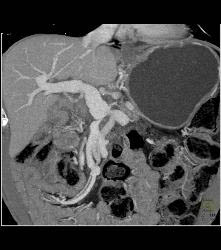 Antral Carcinoma With Peritoneal Tumor Implants - CTisus CT Scan