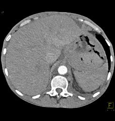 Gastric Lymphoma With Nodes and Ulceration - CTisus CT Scan