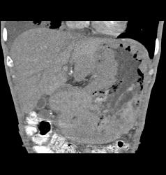 Gastric Lymphoma With Nodes and Ulceration - CTisus CT Scan