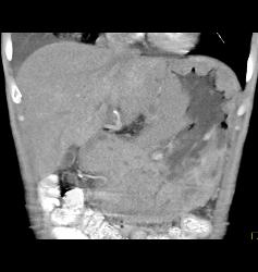 Gastric Lymphoma With Nodes and Ulceration - CTisus CT Scan