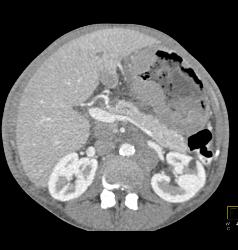 Gastric Lymphoma With Nodes and Ulceration - CTisus CT Scan