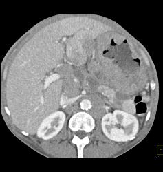 Gastric Lymphoma With Nodes and Ulceration - CTisus CT Scan