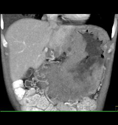 Gastric Lymphoma With Nodes and Ulceration - CTisus CT Scan