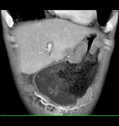 Antral Carcinoma - CTisus CT Scan