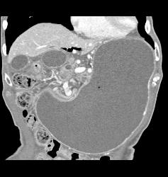 Antral Carcinoma With Gastric Outlet Obstruction - CTisus CT Scan