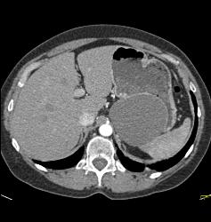 Gastric Duplication Cyst - CTisus CT Scan