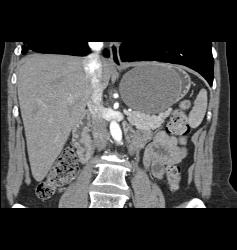 Gastric Duplication Cyst - CTisus CT Scan