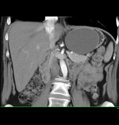 Gastric Duplication Cyst - CTisus CT Scan