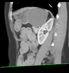 Gastric Duplication Cyst - CTisus CT Scan