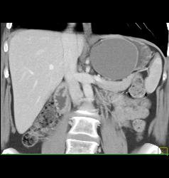 Gastric Duplication Cyst - CTisus CT Scan