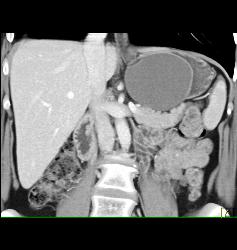 Gastric Duplication Cyst - CTisus CT Scan