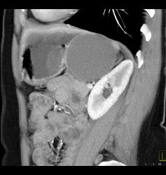 Gastric Duplication Cyst - CTisus CT Scan