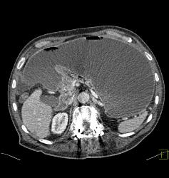 Gastric Outlet Obstruction Due to Carcinoma - CTisus CT Scan