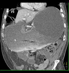 Gastric Outlet Obstruction Due to Carcinoma - CTisus CT Scan