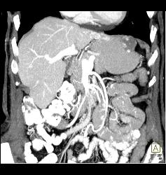 Gastric Tumor With Adenopathy and Implants Near Diaphragm - CTisus CT Scan