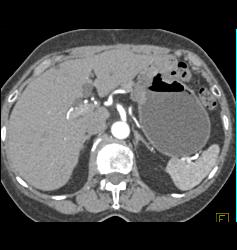 Tumor Recurrence At Gastric Anastomosis - CTisus CT Scan