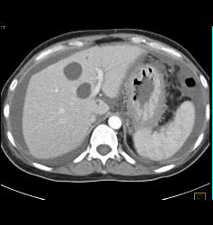 Linitis Plastica With Carcinomatosis - CTisus CT Scan