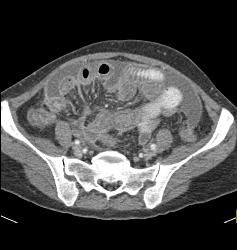 Linitis Plastica With Carcinomatosis - CTisus CT Scan