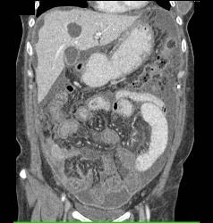 Linitis Plastica With Carcinomatosis - CTisus CT Scan