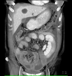 Linitis Plastica With Carcinomatosis - CTisus CT Scan