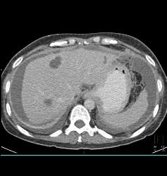 Linitis Plastica With Carcinomatosis - CTisus CT Scan