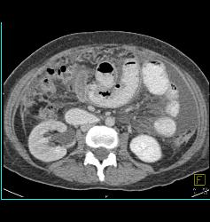 Linitis Plastica With Carcinomatosis - CTisus CT Scan