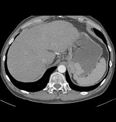 Gastric Varices Simulates A Tumor- See Sequence With Delayed Phase Images - CTisus CT Scan