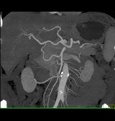 Gastric Varices Simulates A Tumor- See Sequence With Delayed Phase Images - CTisus CT Scan