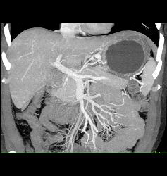 Gastric Varices Simulates A Tumor- See Sequence With Delayed Phase Images - CTisus CT Scan