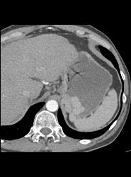 Gastric Varices Simulates A Tumor- See Sequence With Delayed Phase Images - CTisus CT Scan