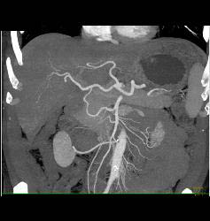 Gastric Varices Simulates A Tumor- See Sequence With Delayed Phase Images - CTisus CT Scan