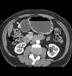 Antral Carcinoma With Gastric Outlet Obstruction - CTisus CT Scan